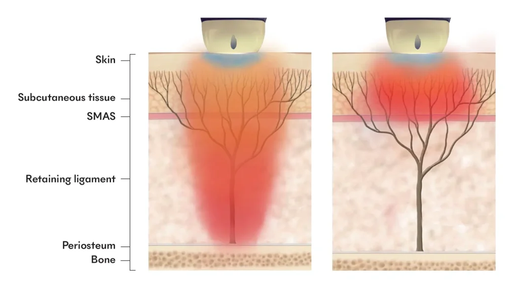 Alma Soprano Titanium Lift delivery modes — cross-section diagram showing laser energy reaching skin, subcutaneous tissue, SMAS, retaining ligament, periosteum, and bone