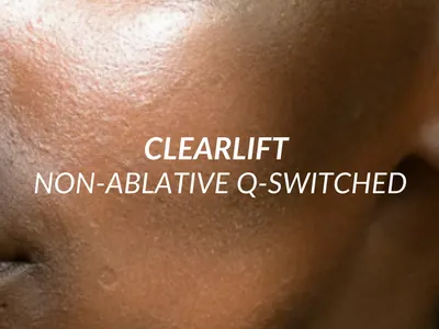 ClearLift non-ablative Q-switched laser treatment at Beauty Ranch Medical Spa
