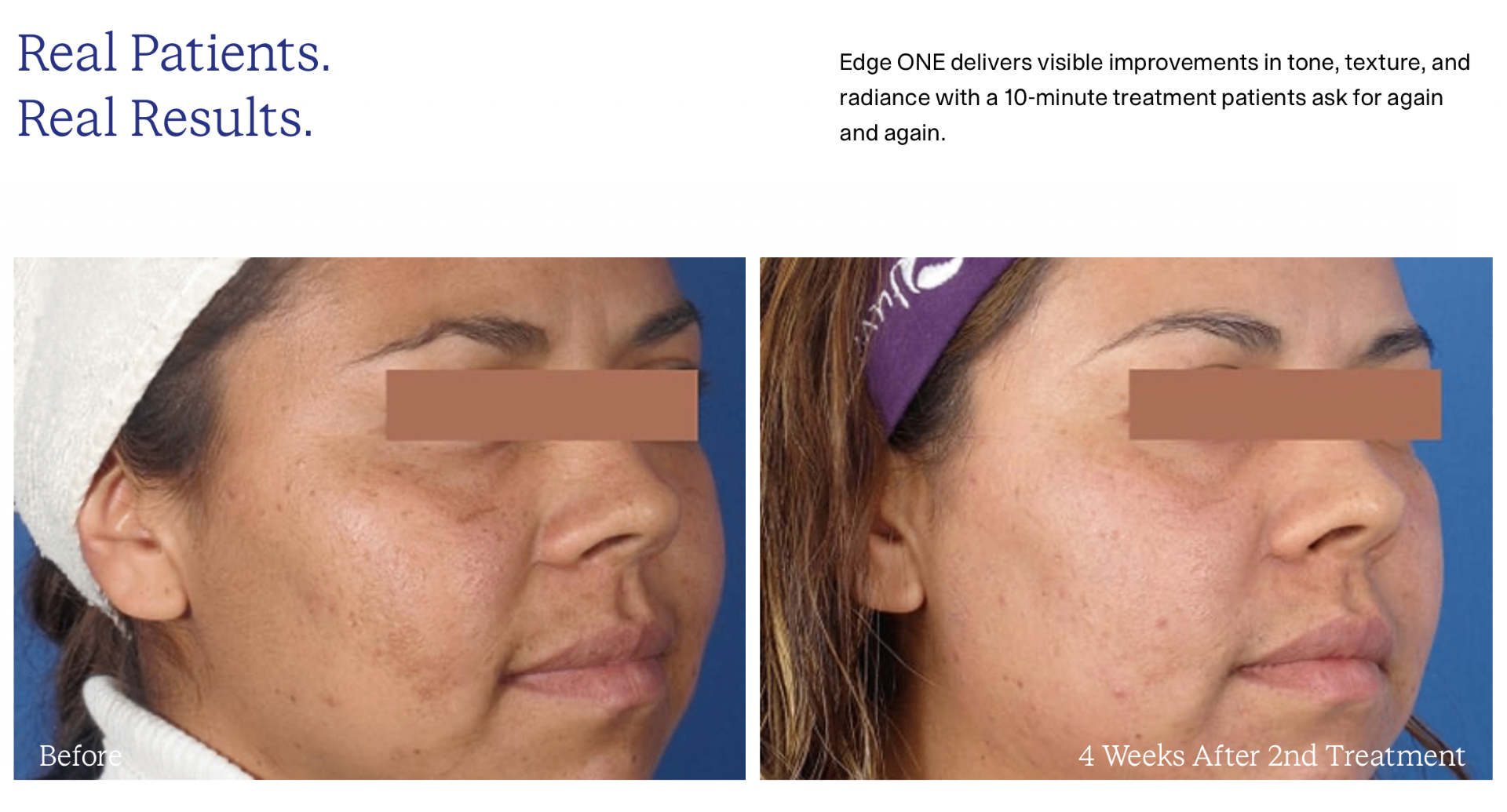 Edge ONE CO₂ laser before and after results at Beauty Ranch Medical Spa in Brentwood, Los Angeles — smoother skin texture, more even tone, and reduced fine lines after 2 treatments.